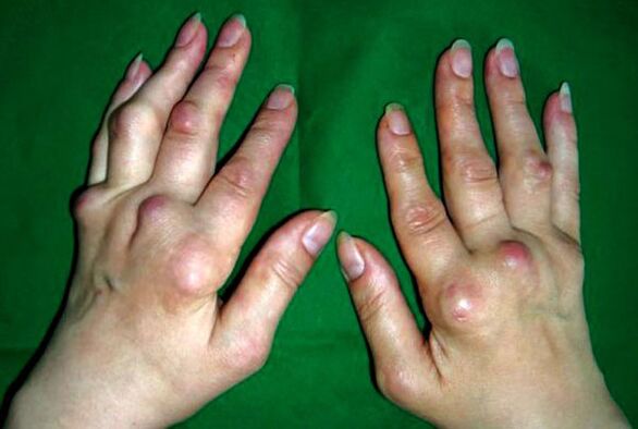 Deformējošā poliosteoartrīta skartās rokas
