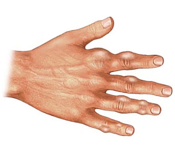 Urīnskābes kristālu nogulsnēšanās pirkstu mīkstajos audos ar podagras artrītu