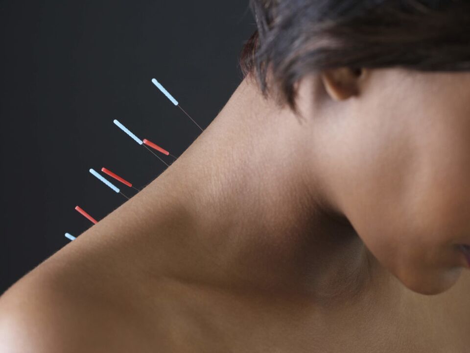 Dzemdes kakla osteohondrozes akupunktūra novērš iekaisuma procesus